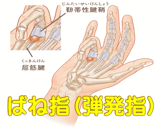 ばね指 弾発指