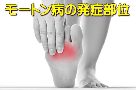 八戸モートン病整体の説明