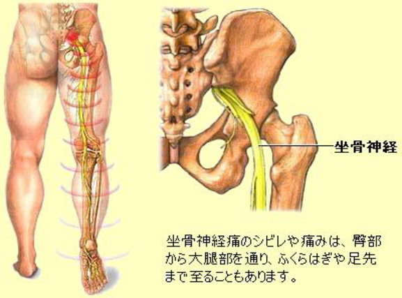 八戸整体 坐骨神経痛